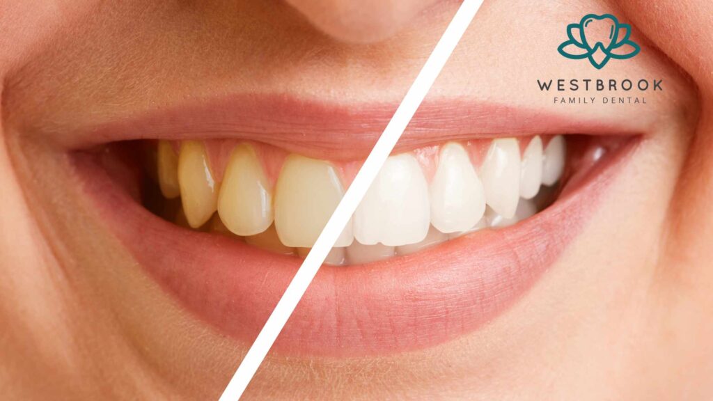 teeth whitening treatment
