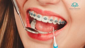 Teeth Braces for Adults