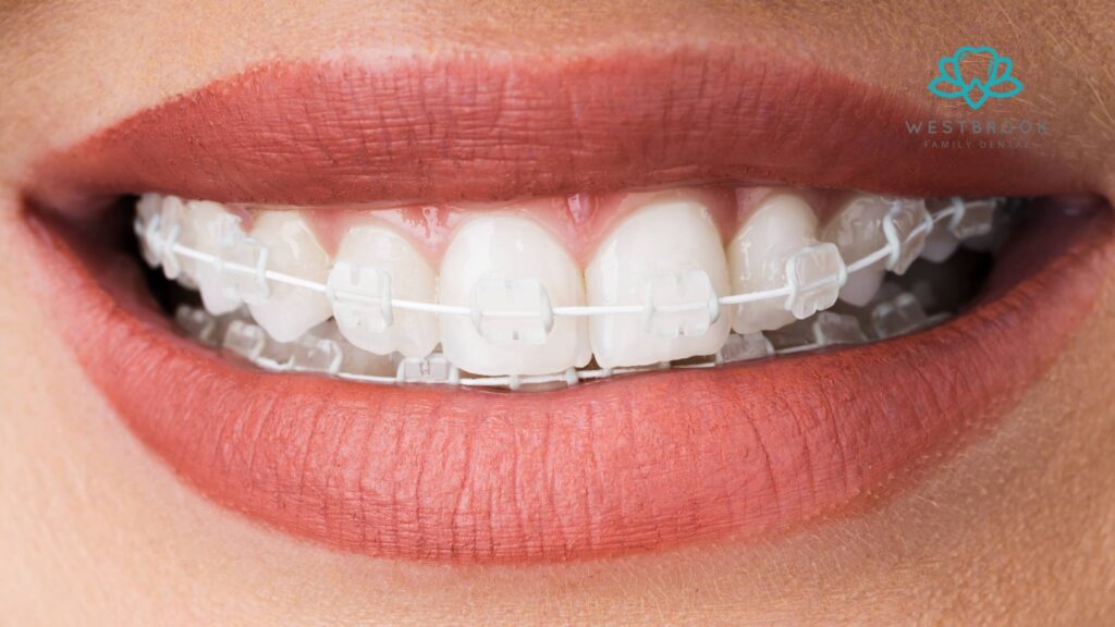 Clear Invisalign