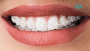 Clear Invisalign
