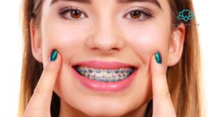 Teeth Braces for Adults