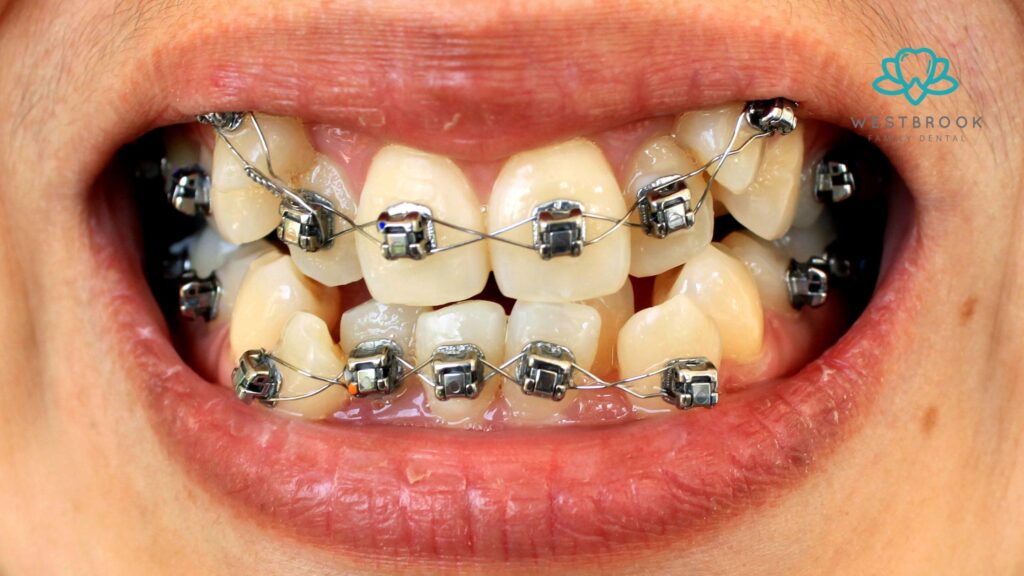 Teeth Braces for Adults