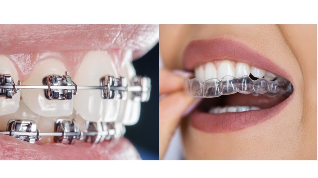 How Long Do Teeth Braces for Adults Take A Complete Timeline Types of Teeth Braces