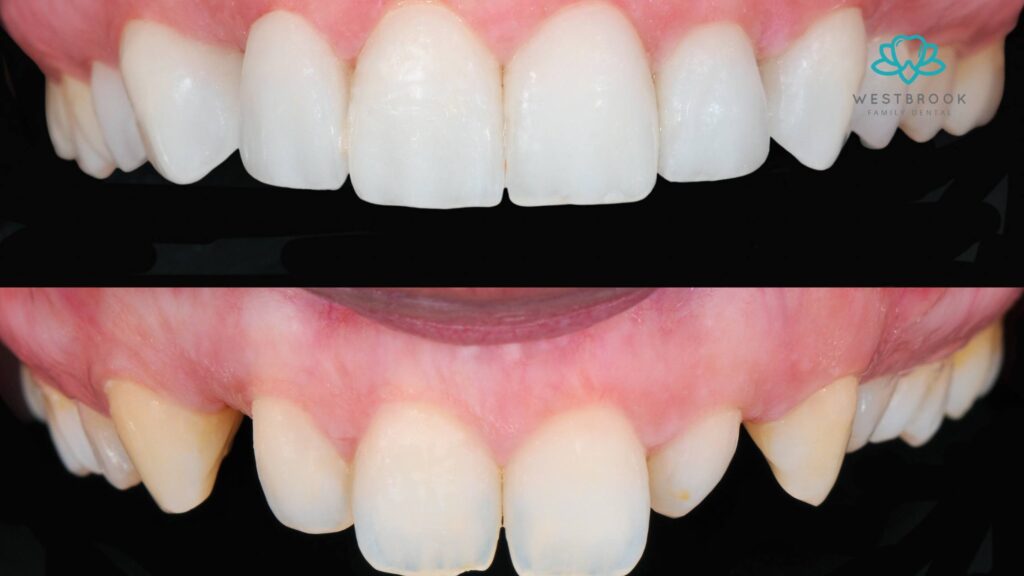 Invisalign For Adults