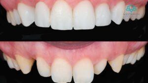Invisalign For Adults