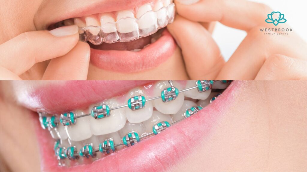 How Much Invisalign Costs vs Braces: Which One Is Worth It? Westbrook Dental