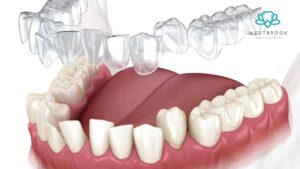 Invisalign Dentist Near Me