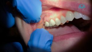 Tooth Abscess