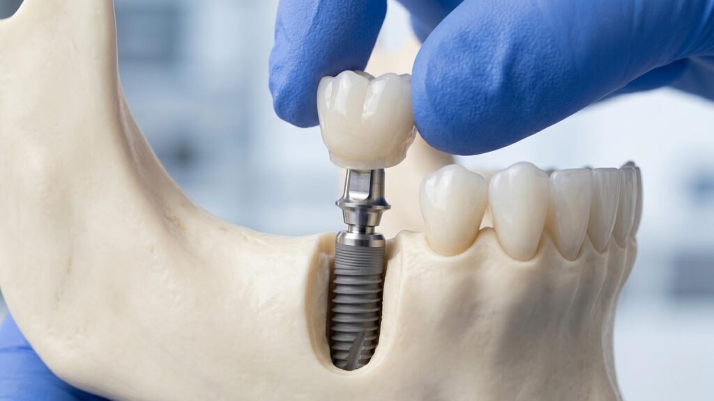 The Complete Guide to Your Dental Implant Procedure: What to Expect from Start to Finish Westbrook Dental